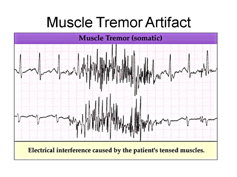 Muscle Tremor Artifact